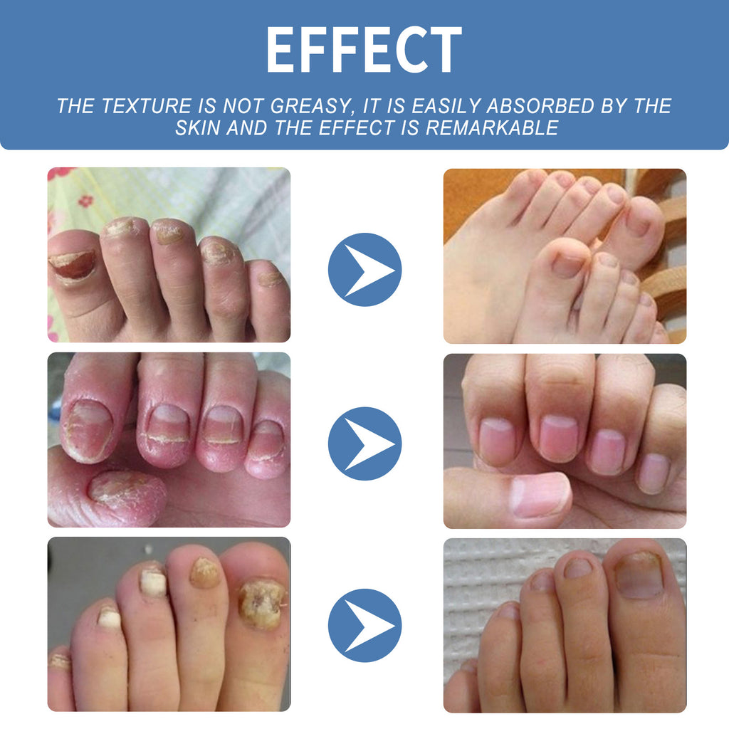 OUHOE Nail Care Gel for Thickening and Repairing Nails